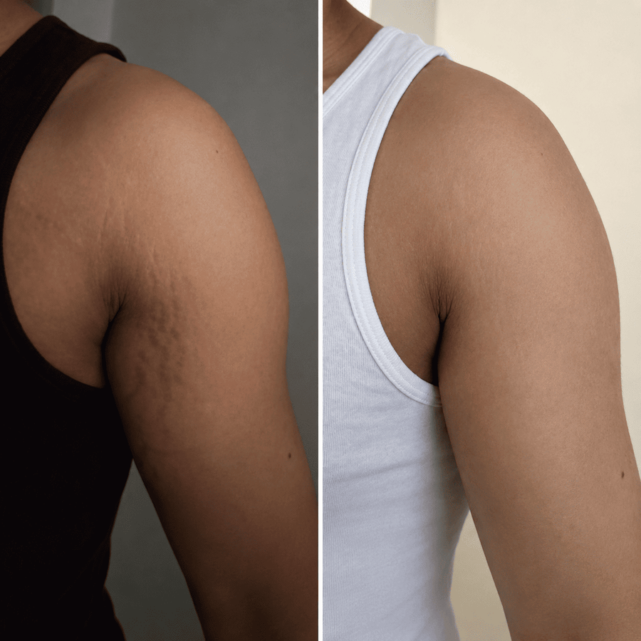Gym Stretch Marks