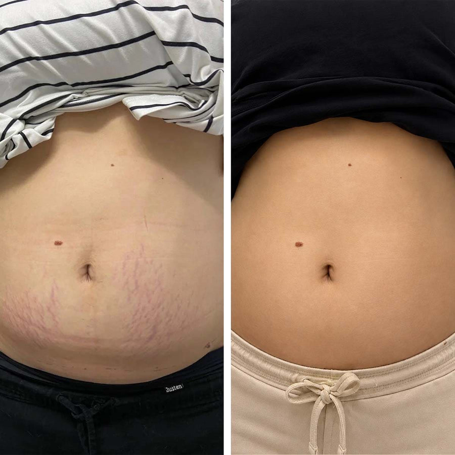 Post-Partum Stretch Marks