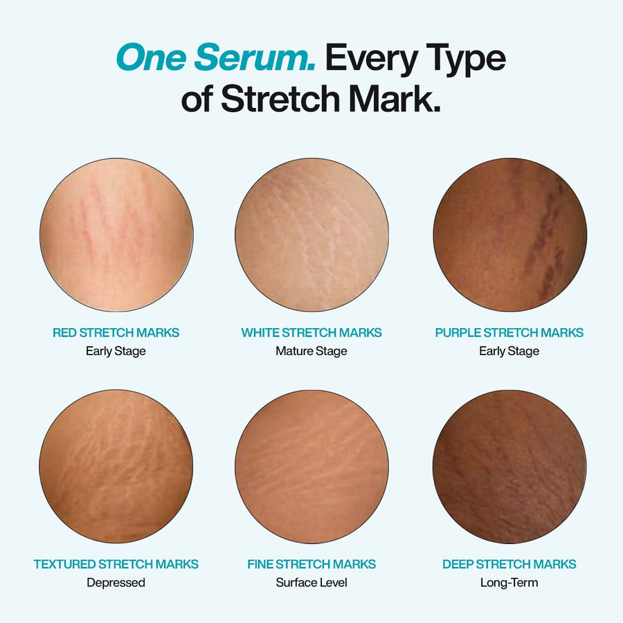 Anti-Stretch Marks Serum