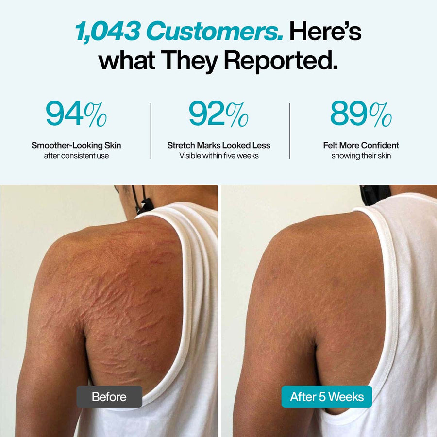 Anti-Stretch Marks Serum